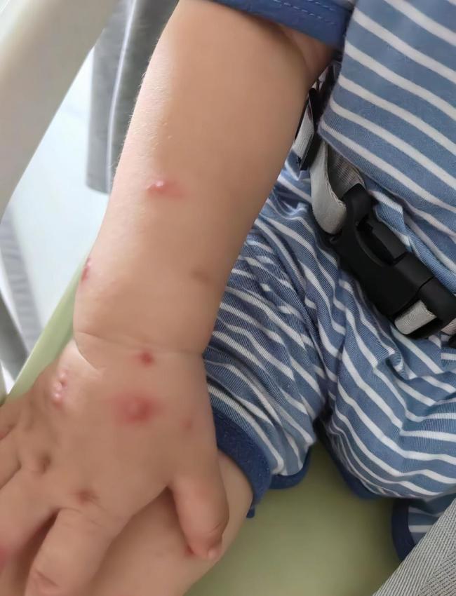 强搂亲吻孩子致水痘双方已达成和解 亲密接触引发传染风险